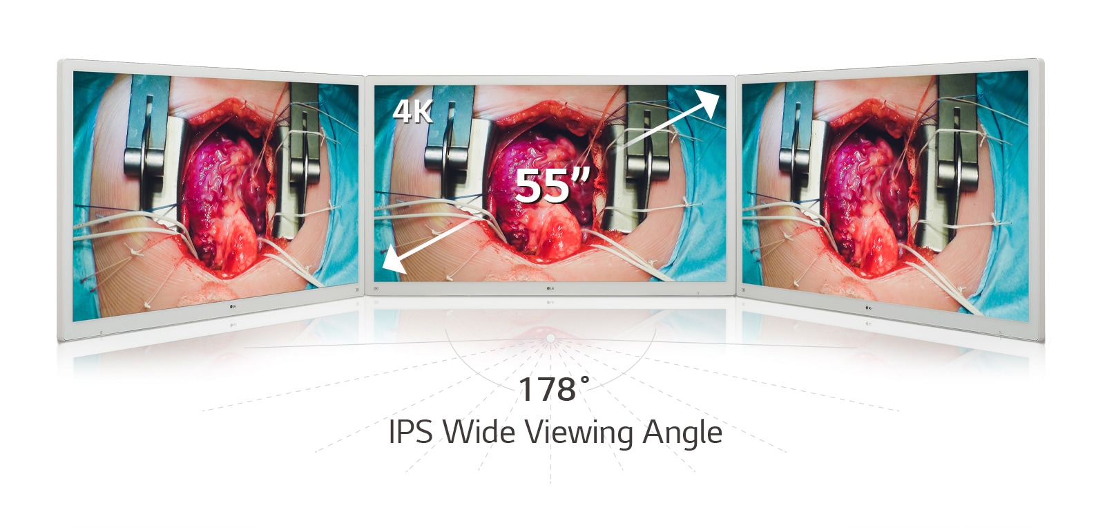 Experience vivid images on LG’s 55-inch 4K Display Surgical Monitor, equipped with an IPS panel that offers a wide 178° viewing angle.
