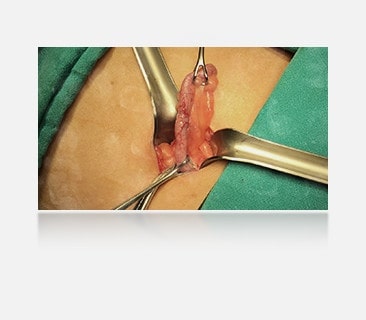 The right image, with anti-fingerprint coating, is clear, without smudges, providing a better view of the surgical area.	