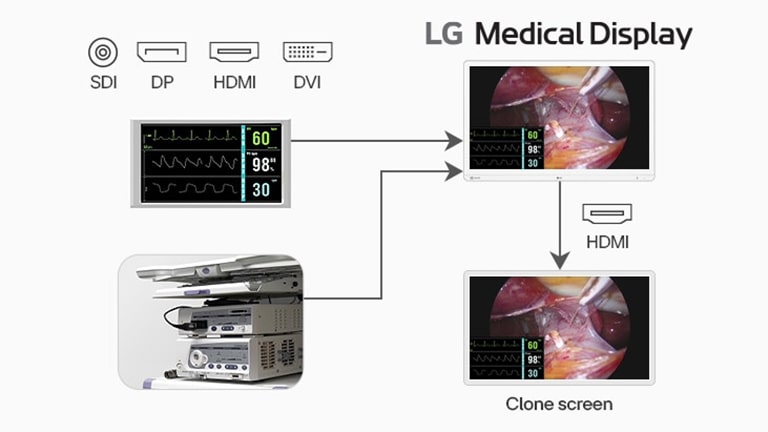 The image shows the clone screen feature of an LG medical display, which replicates content to a second monitor via HDMI, aiding surgical team collaboration.	