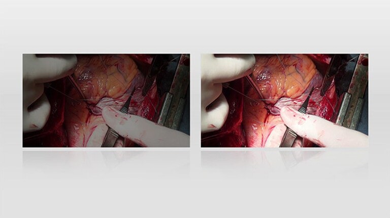 The video compares a surgical display with and without optical bonding. The right, with optical bonding, is brighter and clearer than the left.	