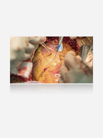 The right image, with anti-reflection coating, offers a clearer view with reduced glare.	