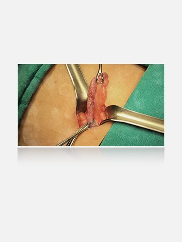 The right image, with anti-fingerprint coating, is clear, without smudges, providing a better view of the surgical area.	