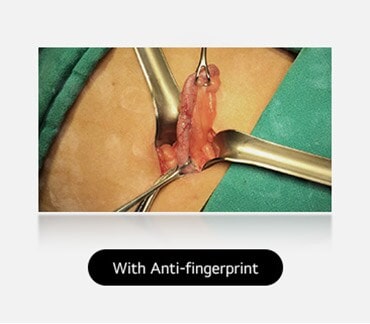 The right image, with anti-fingerprint coating, is clear, without smudges, providing a better view of the surgical area.	
