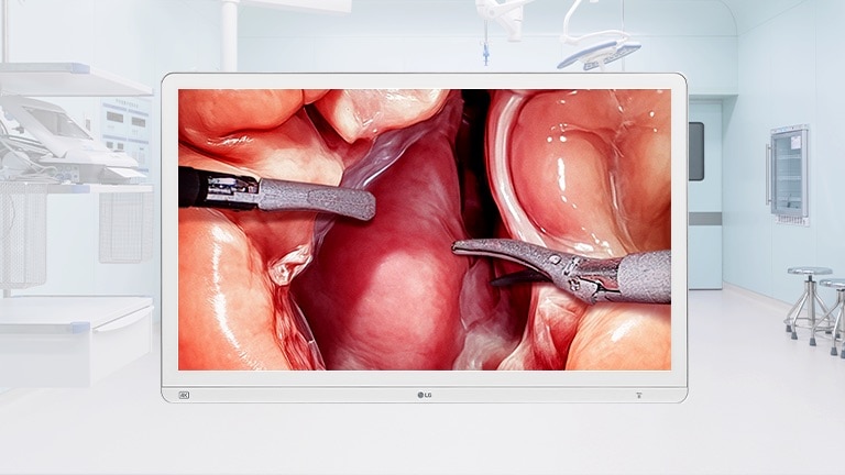 شاشة جراحية 4K مقاس 32 بوصة تعرض صورة جراحية عالية الدقة، موضوعة في بيئة غرفة عمليات حديثة.