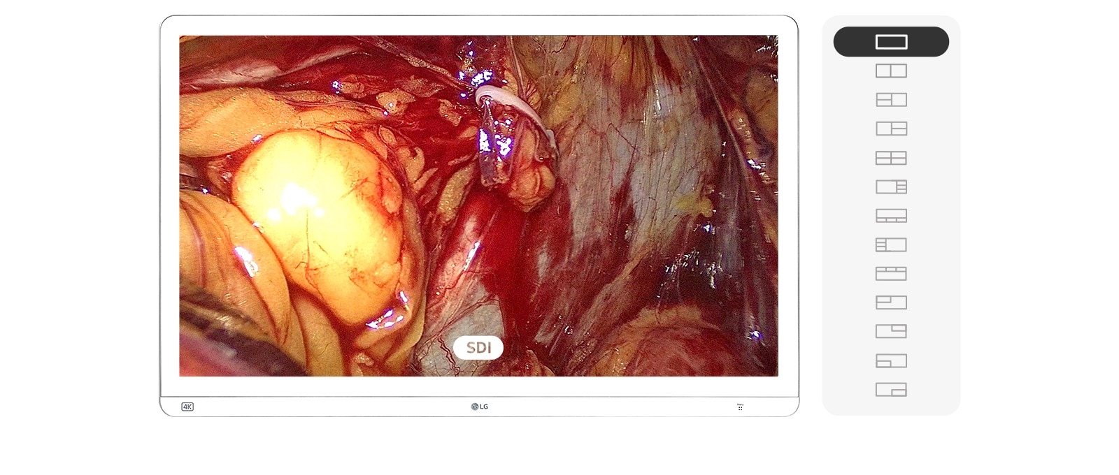 يعرض الفيديو شاشة طبية تقوم بتبديل أوضاع الشاشة على الفور باستخدام مفاتيح التشغيل السريع، مما يتيح عرض فيديو جراحي متعدد المصادر في الوقت الفعلي من مداخل SDI وHDMI وDisplayPort.