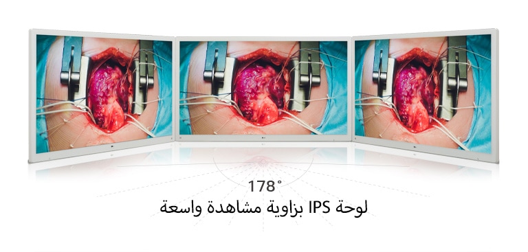 استمتع بصور نابضة بالحياة على شاشة العرض الجراحية بدقة 4K مقاس 55 بوصة من LG، المزودة بلوحة IPS التي توفر زاوية عرض واسعة تبلغ 178 درجة.