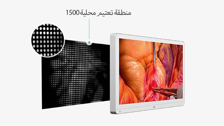 شاشة طبية تعرض صورة جراحية، إلى جانب رسم توضيحي يُبرز 1,500 منطقة تعتيم محلي مع إبراز التحكم المحسن في الإضاءة الخلفية لتعزيز كفاءة الطاقة والمتانة.