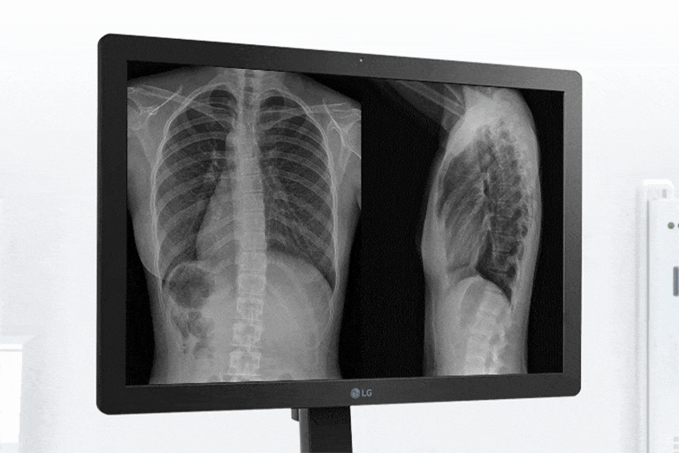 Avec une luminosité élevée 600 cd/m², ce moniteur d'examen clinique convient aussi au diagnostic.