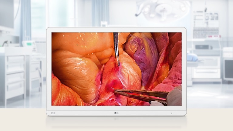 Moniteur chirurgical Mini-LED 4K 27&nbsp;pouces affichant une image chirurgicale haute résolution, dans un environnement de salle d’opération moderne.