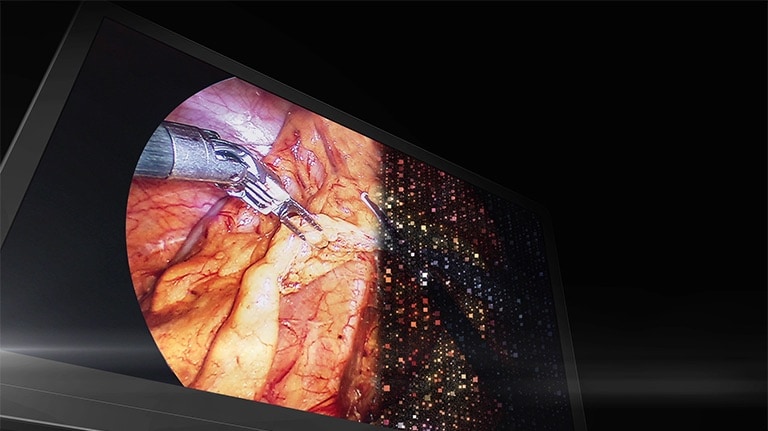 La vidéo présente un écran chirurgical Mini-LED avec des zones de Rétroéclairage local 1,5&nbsp;K, en mettant en valeur le contrôle de luminosité amélioré et une luminosité maximale de 2&nbsp;000&nbsp;cd/m² pour une expérience visuelle chirurgicale immersive.
