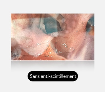 L’image de gauche montre un écran sans anti-scintillement, avec des reflets et des scintillements qui obscurcissent le visuel.