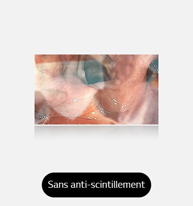 L’image de gauche montre un écran sans anti-scintillement, avec des reflets et des scintillements qui obscurcissent le visuel.