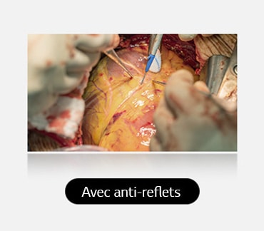 L’image de droite, avec un revêtement anti-reflets, offre un visuel plus clair avec un scintillement réduit.