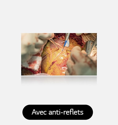 L’image de droite, avec un revêtement anti-reflets, offre un visuel plus clair avec un scintillement réduit.