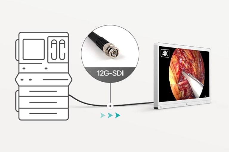 L’image montre une connexion 12G-SDI entre un système d’imagerie médical et un écran 4K, indiquant une transmission vidéo haute définition.