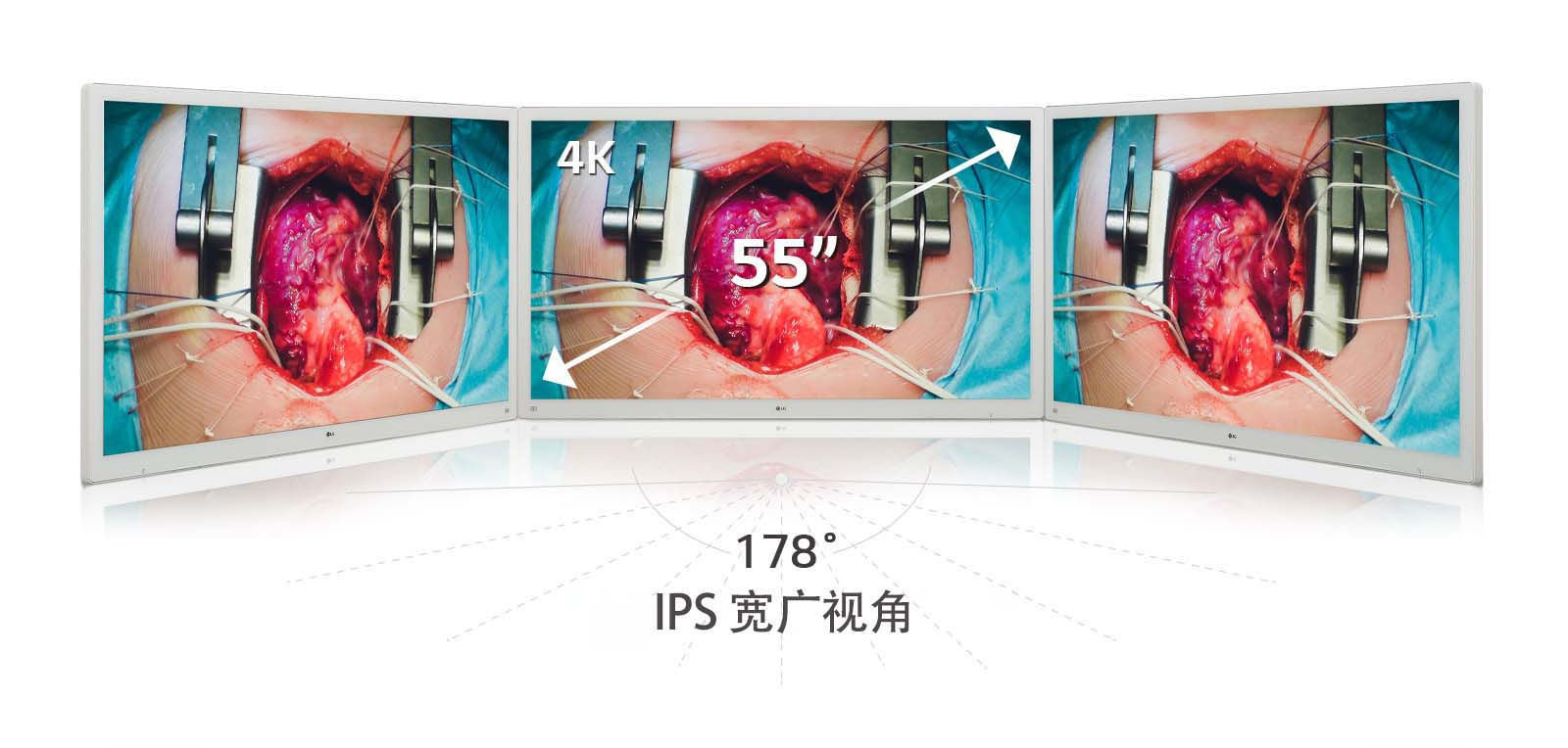 使用 LG 55 英寸 4K 手术显示器，配备 IPS 面板，提供 178° 广视角，呈现清晰生动的图像。