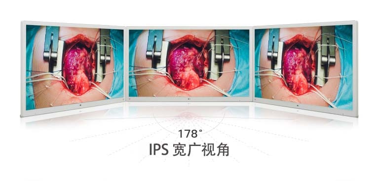 使用 LG 55 英寸 4K 手术显示器，配备 IPS 面板，提供 178° 广视角，呈现清晰生动的图像。