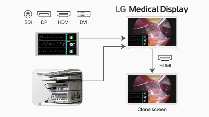 The image shows the clone screen feature of an LG medical display, which replicates content to a second monitor via HDMI, aiding surgical team collaboration.	