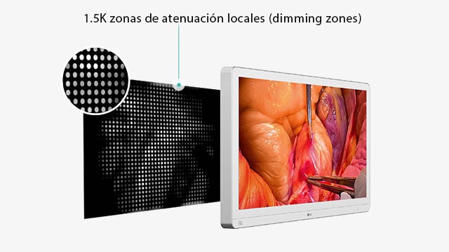 Monitor médico con imágenes quirúrgicas en la pantalla y un diagrama que muestra 1,5K zonas de atenuación locales, destacando el control de la luz trasera para una mejora de la eficiencia energética y la durabilidad.