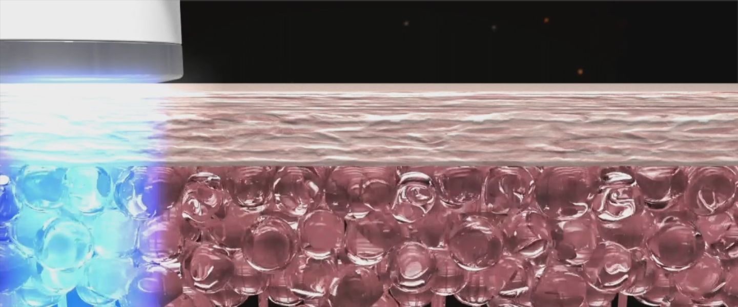 This video shows cooling coming out of the Intensive Multicare product and lowering the temperature of the skin.