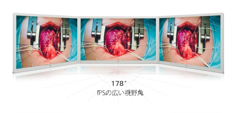 178°の幅広い視野角を提供するIPSパネルを搭載したLGの55型4Kディスプレイ外科用モニターが、くっきりとした映像を実現。