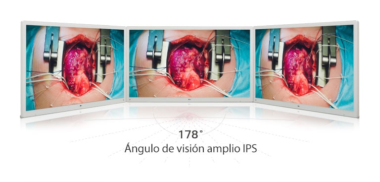 Experimente imágenes vívidas en el monitor quirúrgico con pantalla 4K de 55 pulgadas de LG, equipado con un panel IPS que ofrece un amplio ángulo de visión de 178°.