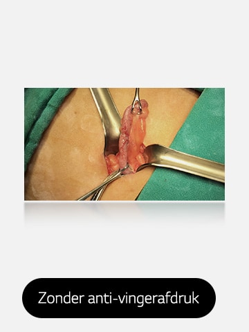 De rechterfoto, voorzien van een anti-vingerafdrukcoating, is helder en vlekkeloos, waardoor u beter zicht hebt op het operatiegebied.