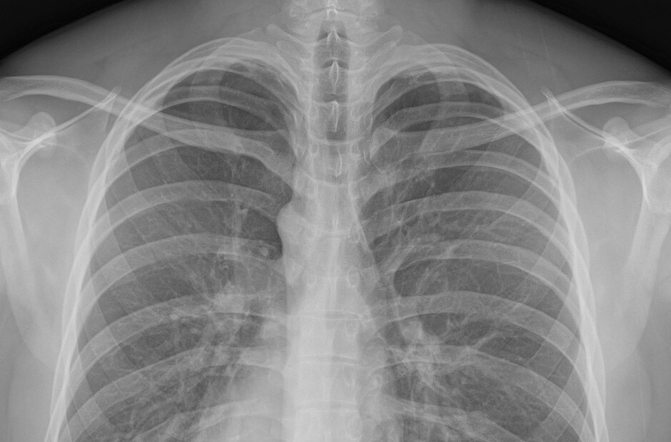 ภาพ X-ray รูปที่ 2