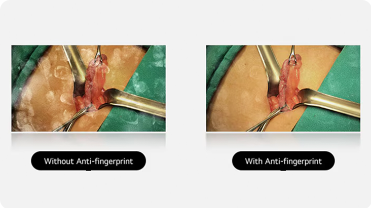 The left image shows a display with visible fingerprints and smudges, obstructing the view. The right image, with anti-fingerprint coating, is clear, without smudges, providing a better view of the surgical area.