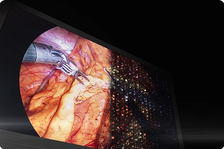 The video promotes a Mini-LED surgical display with 1.5K local dimming zones, emphasizing enhanced brightness control, high contrast, and peak brightness of 2,000 cd/m² for an immersive surgical viewing experience.