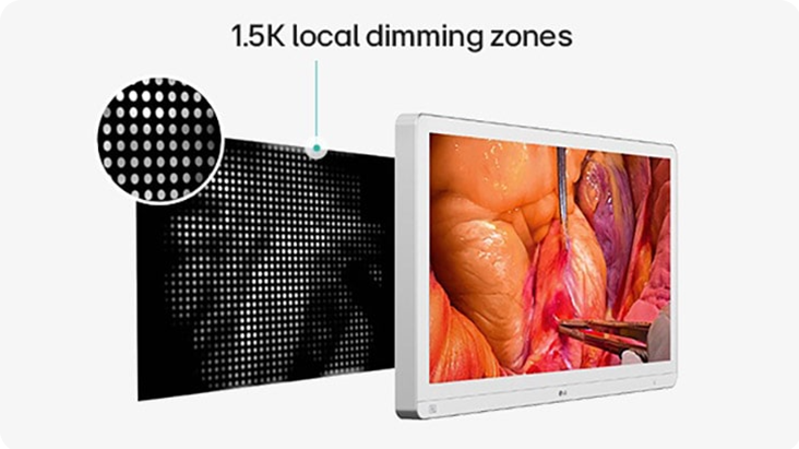 Medical monitor with surgical image shown on screen and a diagram illustrating 1.5K local dimming zones, highlighting enhanced backlight control for improved energy efficiency and durability.