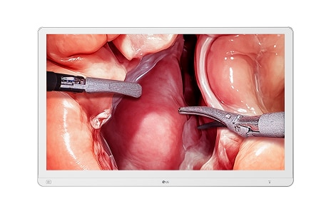 Um monitor médico mostra uma visão em detalhe de um procedimento cirúrgico, mostrando tecidos internos e instrumentos.