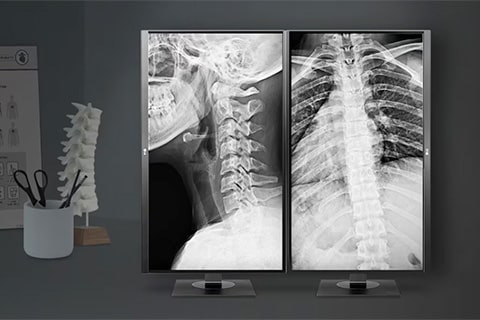 Configuración de pantalla médica que muestra dos imágenes de rayos X de la columna vertebral y el tórax, con un modelo de columna vertebral sobre el escritorio en primer plano.