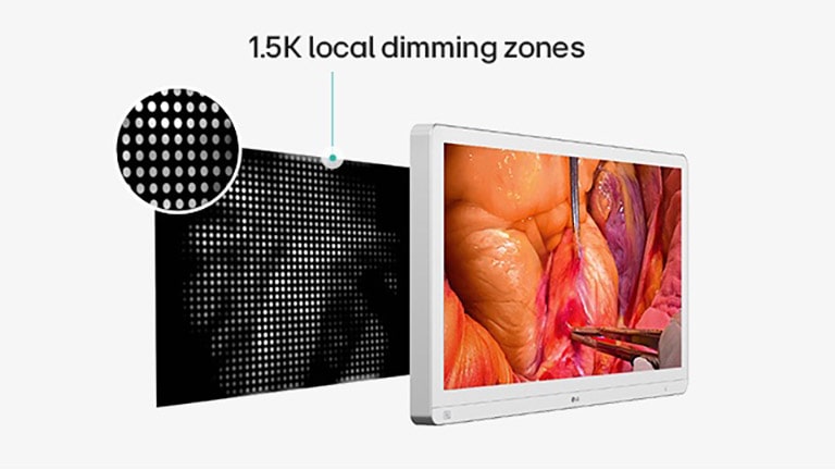 Medical monitor with surgical image shown on screen and a diagram illustrating 1.5K local dimming zones, highlighting enhanced backlight control for improved energy efficiency and durability.