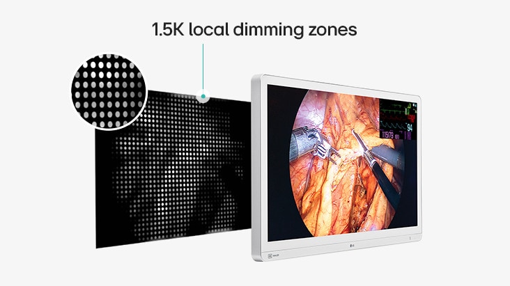 The image highlights a medical monitor with 1.5K local dimming zones, enhancing contrast by precisely controlling brightness in specific screen areas, improving the clarity of surgical visuals.	