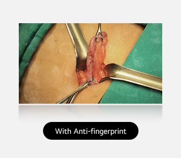 The right image, with anti-fingerprint coating, is clear, without smudges, providing a better view of the surgical area.	