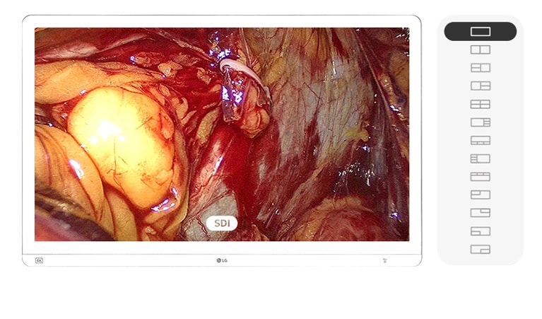 The video shows a medical monitor instantly switching screen modes using hotkeys, enabling real-time multi-source surgical video display from SDI, HDMI, and DisplayPort inputs.