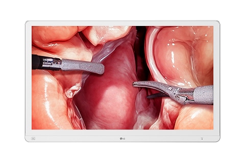 A medical monitor displays a close-up view of a surgical procedure showing internal tissues and instruments.