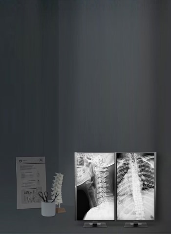 Medical display setup showing two X-ray images of the spine and chest, with a spine model on the desk in the foreground