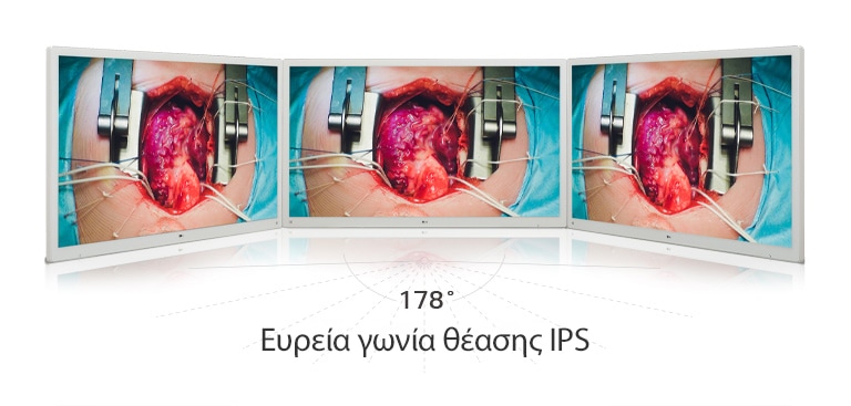 Απολαύστε ζωντανές εικόνες στη χειρουργική οθόνη 55 ιντσών 4K της LG, η οποία είναι εξοπλισμένη με πάνελ IPS που προσφέρει ευρεία γωνία θέασης 178°.