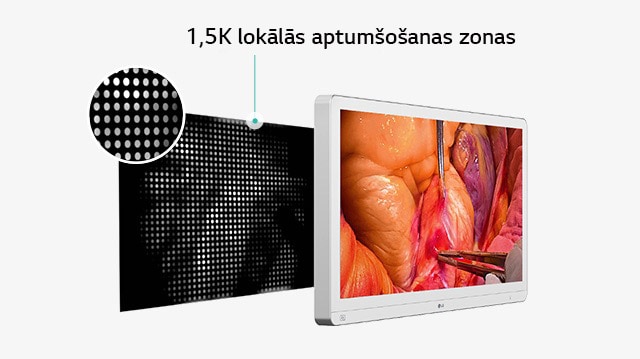 Medicīniskais monitors ar ekrānā redzamu ķirurģisku attēlu un diagrammu, kas ilustrē 1,5K lokālās aptumšošanas zonas, izceļot uzlabotu fona apgaismojuma vadību, lai uzlabotu energoefektivitāti un izturību.