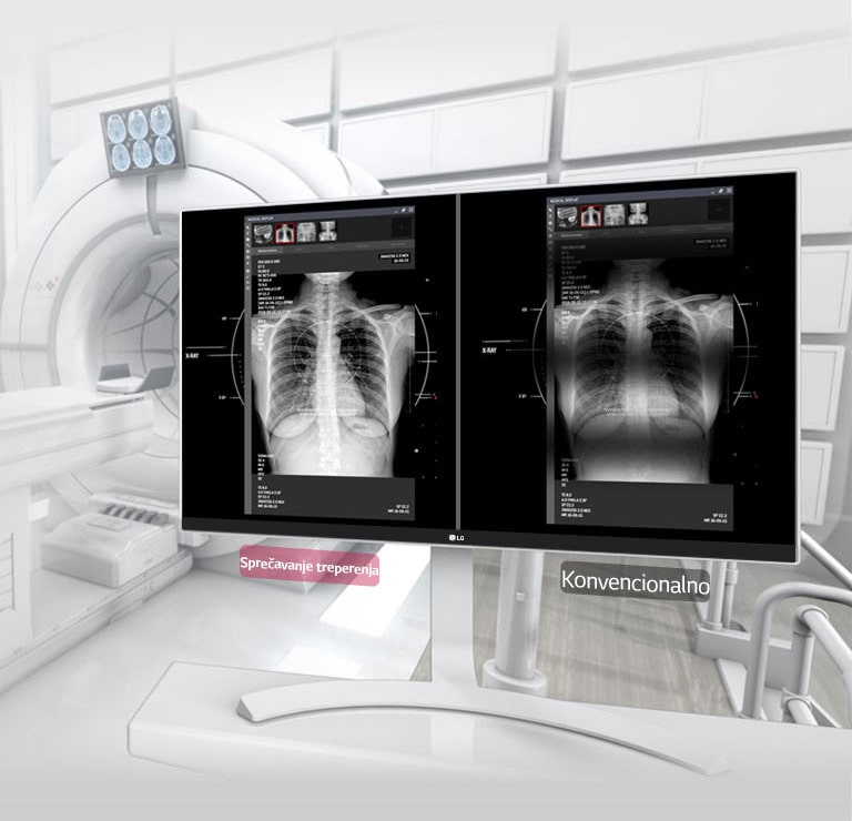 Sprečavanje treperenja<br>2