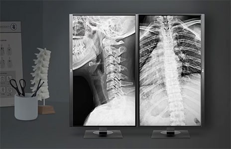 Medical display setup showing two X-ray images of the spine and chest, with a spine model on the desk in the foreground